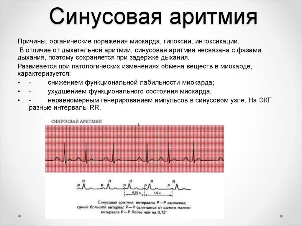 Тахикардия: формы и их отличия, причины, проявления, способы снятия приступа и терапия