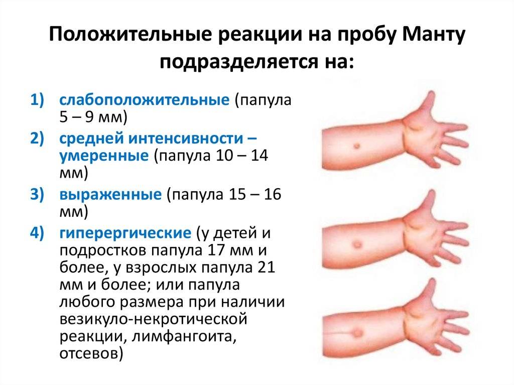 Техника проведения пробы манту: алгоритм введения туберкулина, показания, противопоказания, результаты, можно ли делать ребенку
