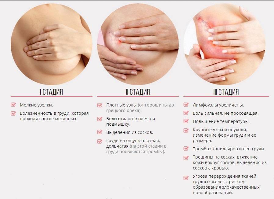 Боль в груди во время кормления: норма или патология?