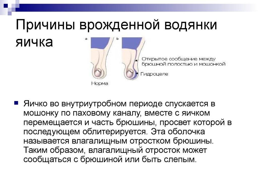 Лечение водянки яичка у новорожденных и взрослых мужчин