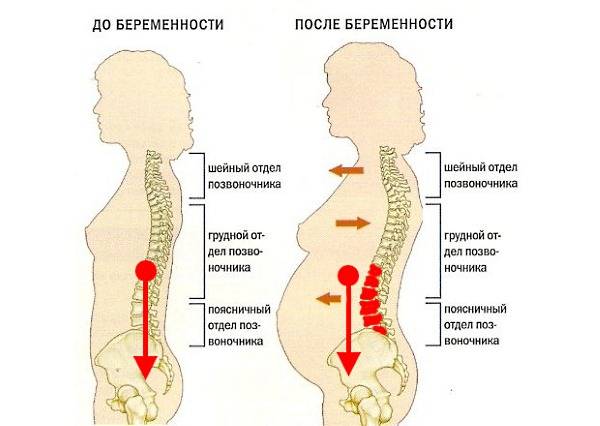 Болит спина при беременности: что делать при болях на ранних сроках