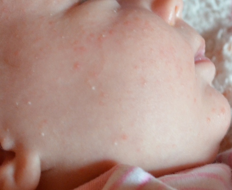 Что делать, если лихорадка у ребёнка сопровождается высыпаниями?
