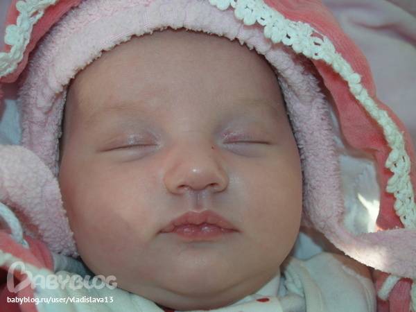 Почему синеет носогубный треугольник. Гемангиома у младенца у новорожденного. Гемангиома у новорожденных Комаровский. Гемангиома на глазу у новорожденного. Поверхностная гемангиома у новорожденных.