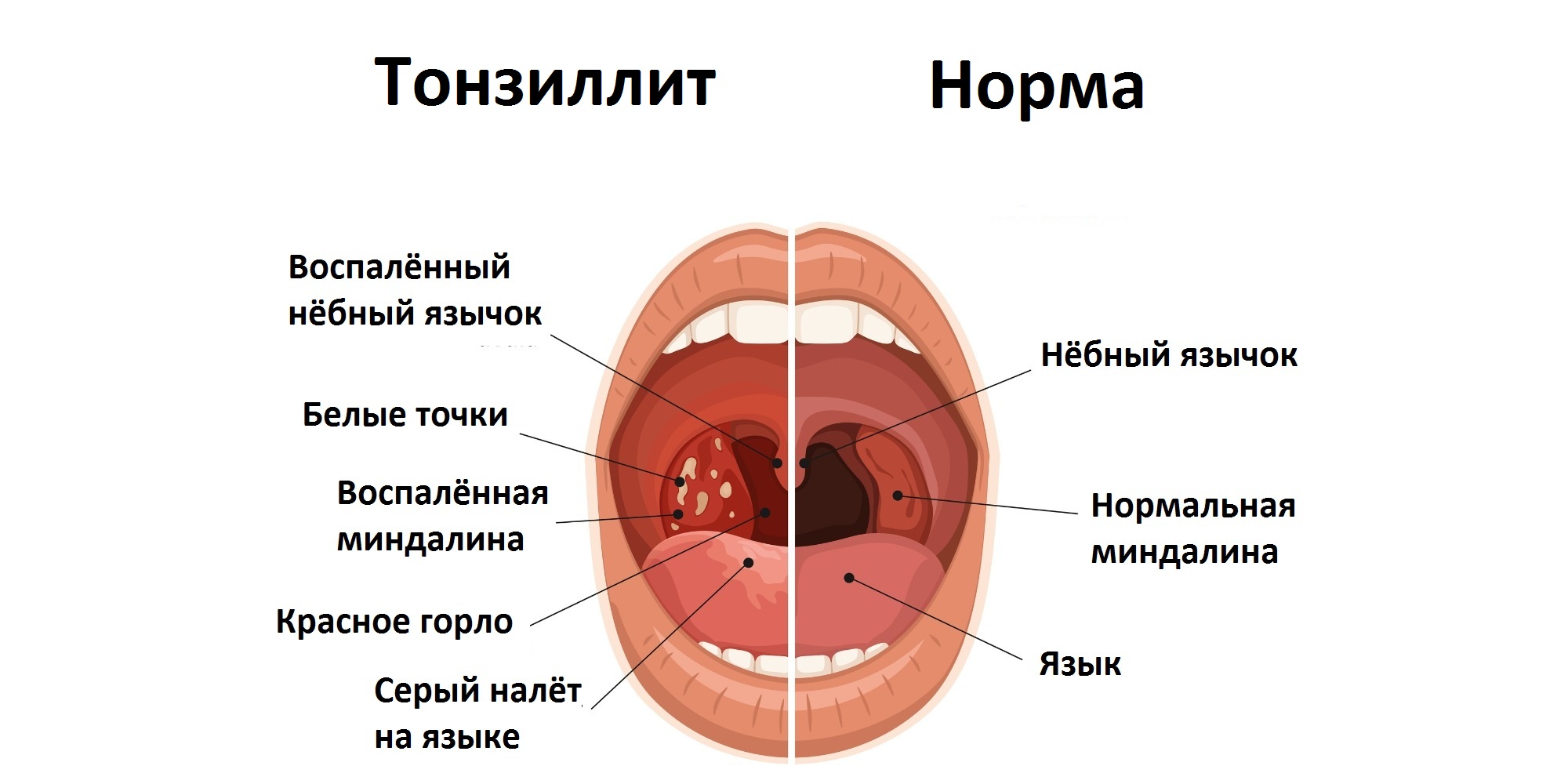 Фолликулярная ангина