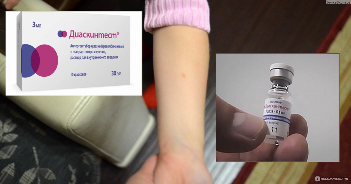 Диагностика туберкулеза. проба манту или диаскинтест?