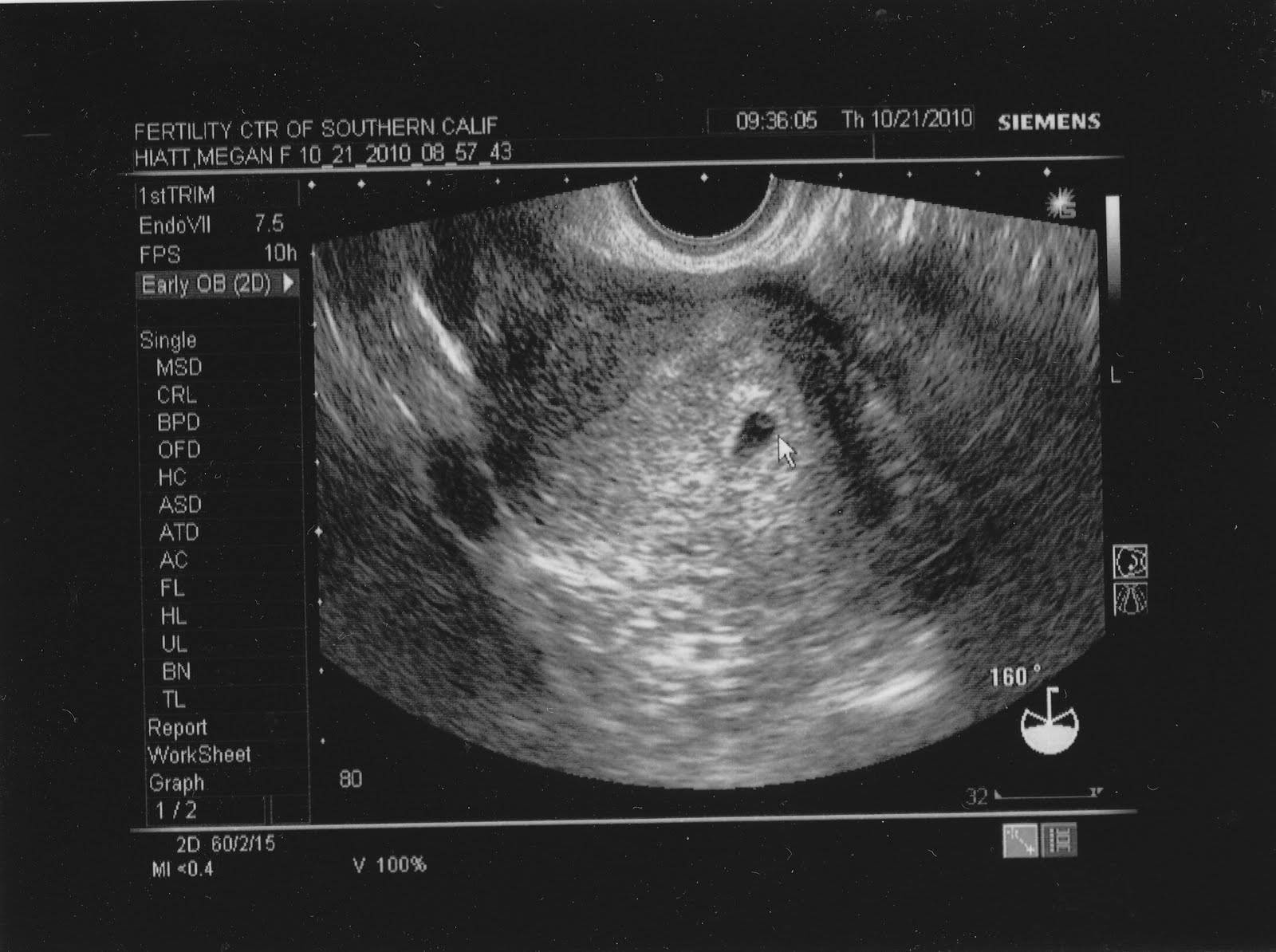 1 неделя беременности: признаки и ощущения, что происходит после зачатия