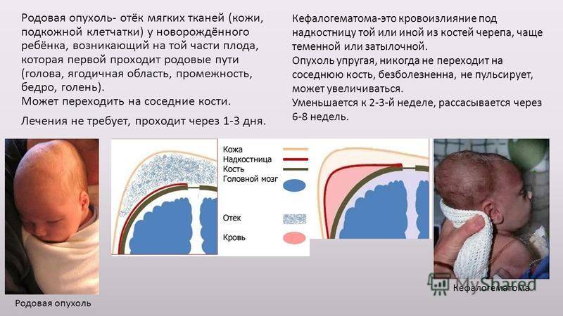 Причины, диагностика и лечение кефалогематомы у новорождённого ребёнка