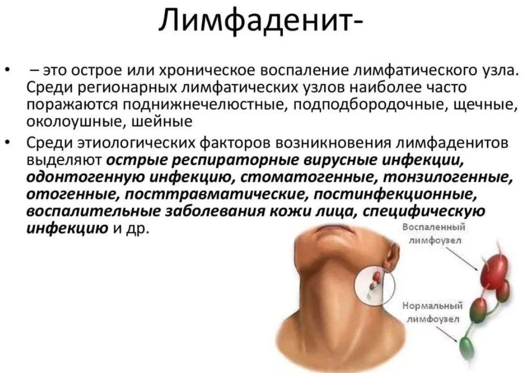 Лимфаденит: лечение воспаления лимфоузлов, симптомы, причины и последствия