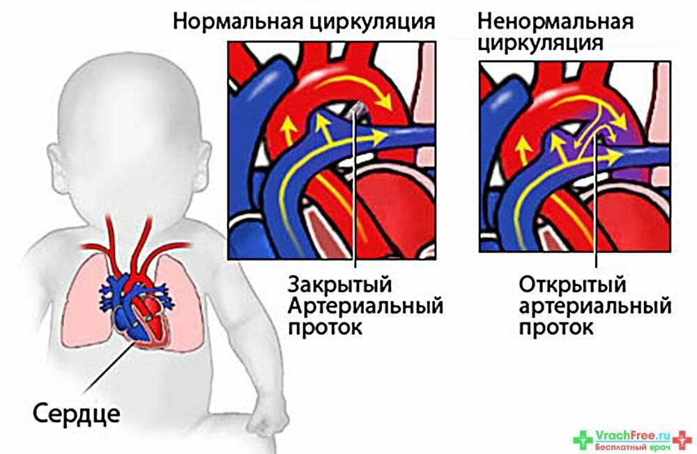 Лечение врожденных пороков сердца | статьи медицинского центра «см-клиника»