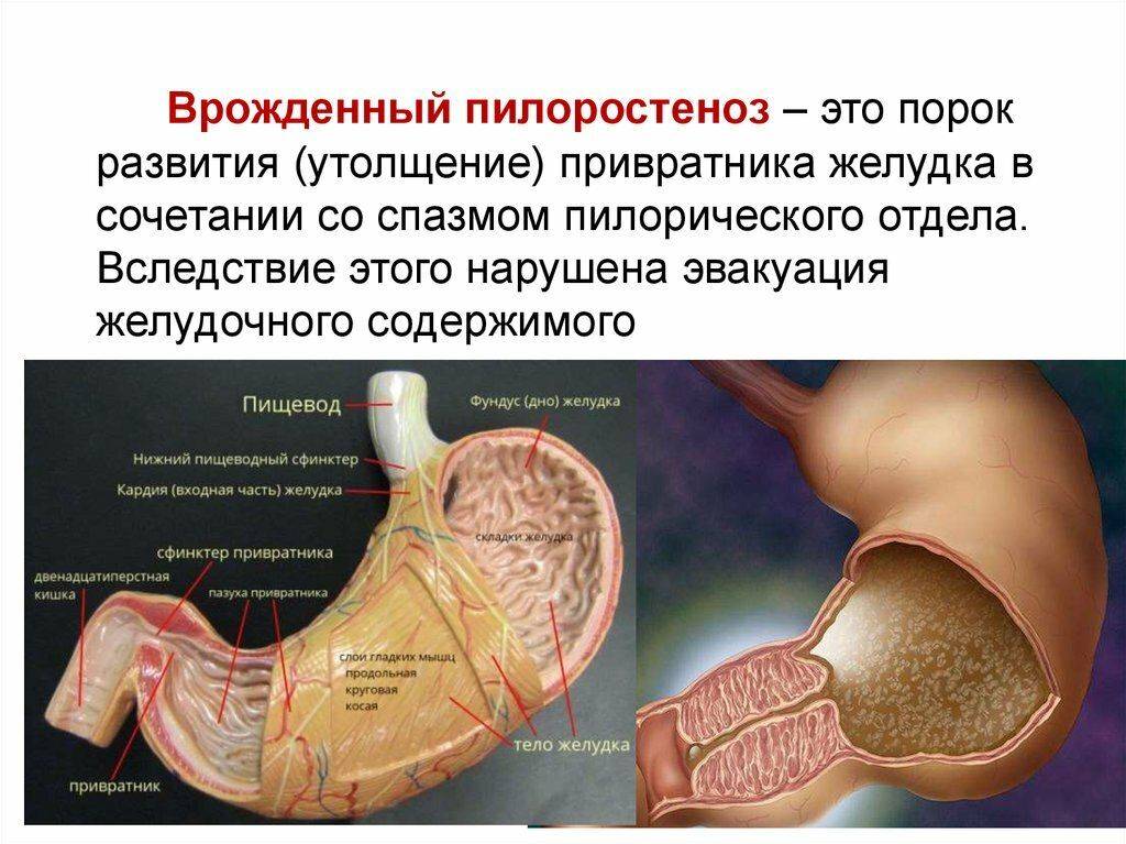 Пилоростеноз у новорожденных: симптоматика, диагностика и лечение | terra-baby.ru