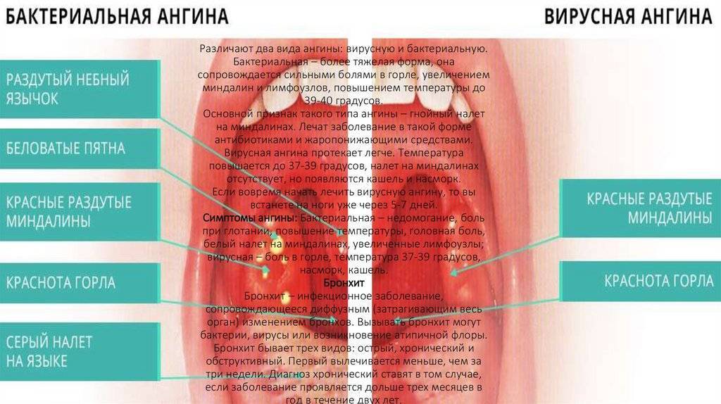 Вирусная ангина у детей