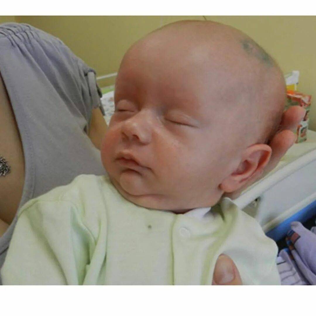 Гидроцефалия у новорождённых: причины, признаки, лечение