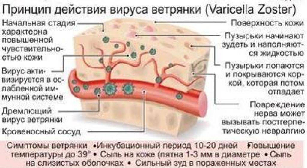 Ветряная оспа
