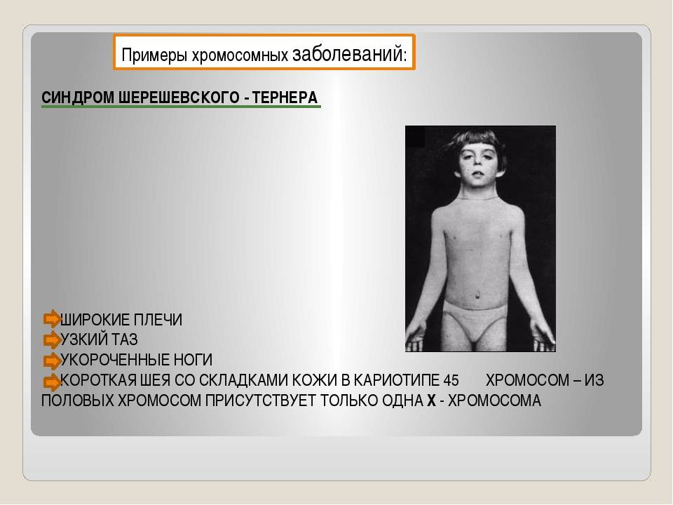 Синдром шерешевского тёрнера : 13 признаков генетического синдрома