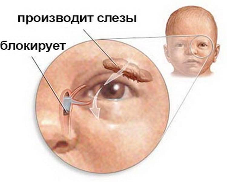 Дакриоцистит у новорождённых и 4 секрета успешного решения проблемы