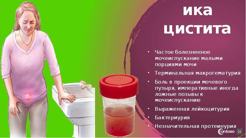 Частое мочеиспускание у детей без боли: причины и симптомы у мальчиков и девочек, народные средства и препараты при лечении ребенка | mfarma.ru
