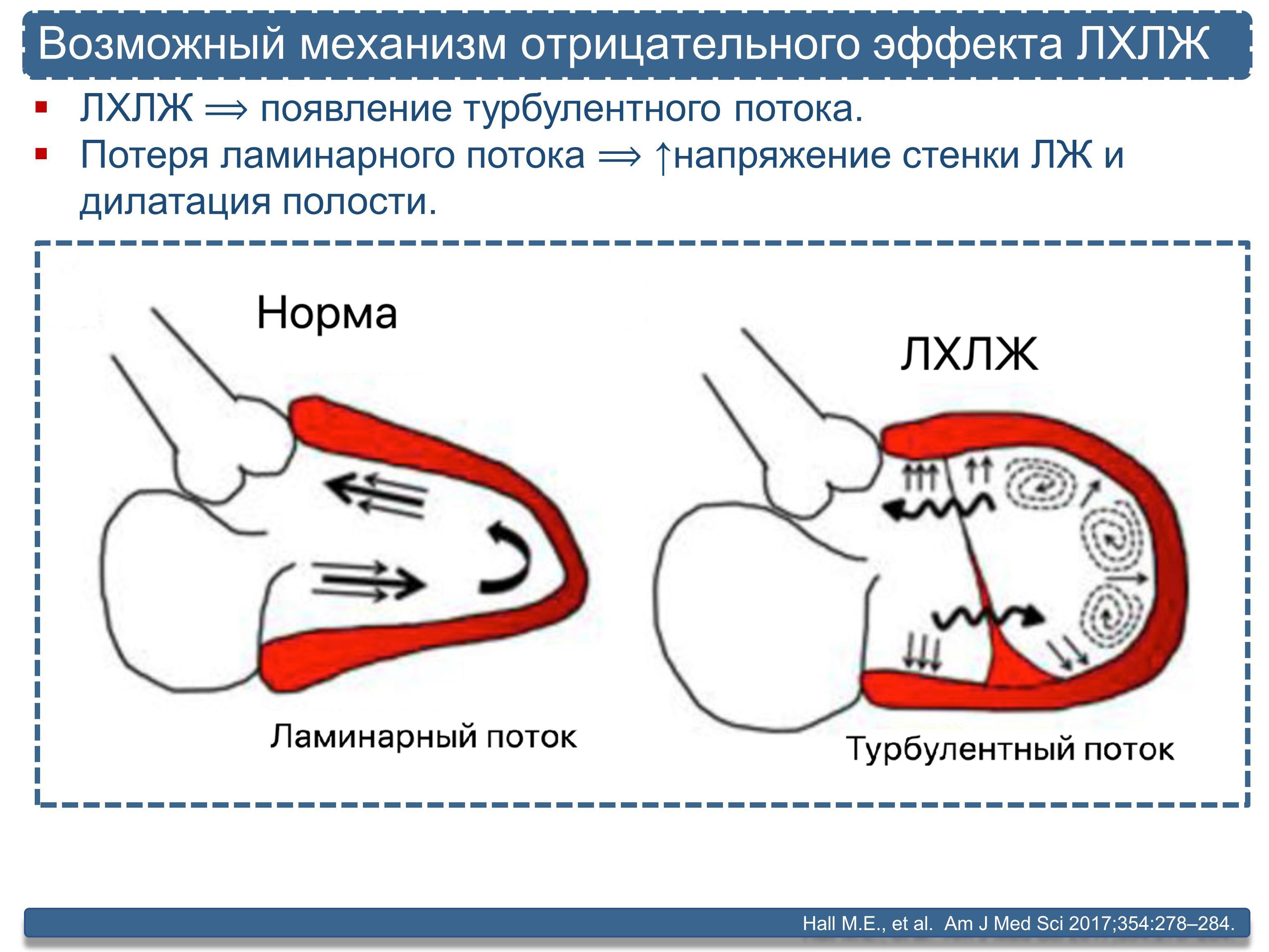 Что такое дополнительная или лишняя хорда в сердце (левом желудочке) у ребенка?
