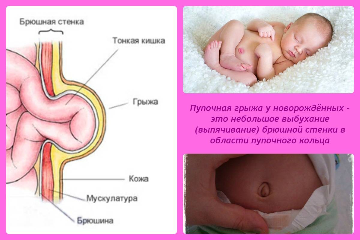 Как ухаживать за пупком новорожденного – heinz baby