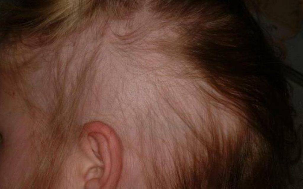 Выпадают волосы 4 месяц. Гнёздная (очаговая алопеция). Гнездная алопеция у детей. Тракционная алопеция у детей.