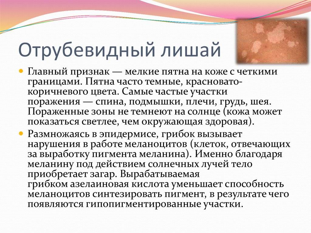 Лишай у ребенка: как понять и что делать для профилактики?