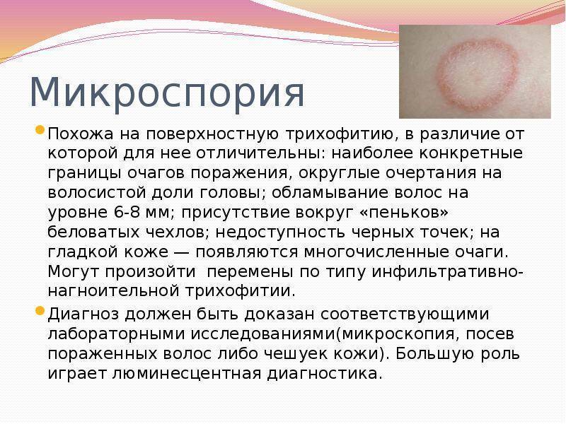 Микроспория у детей: пути заражения, лечение