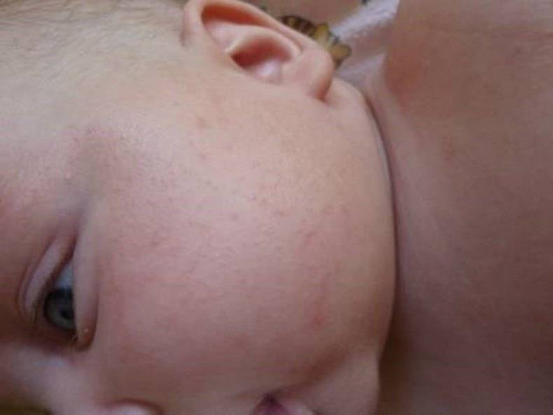 Потница у новорожденных: признаки, лечение и профилактика сыпи