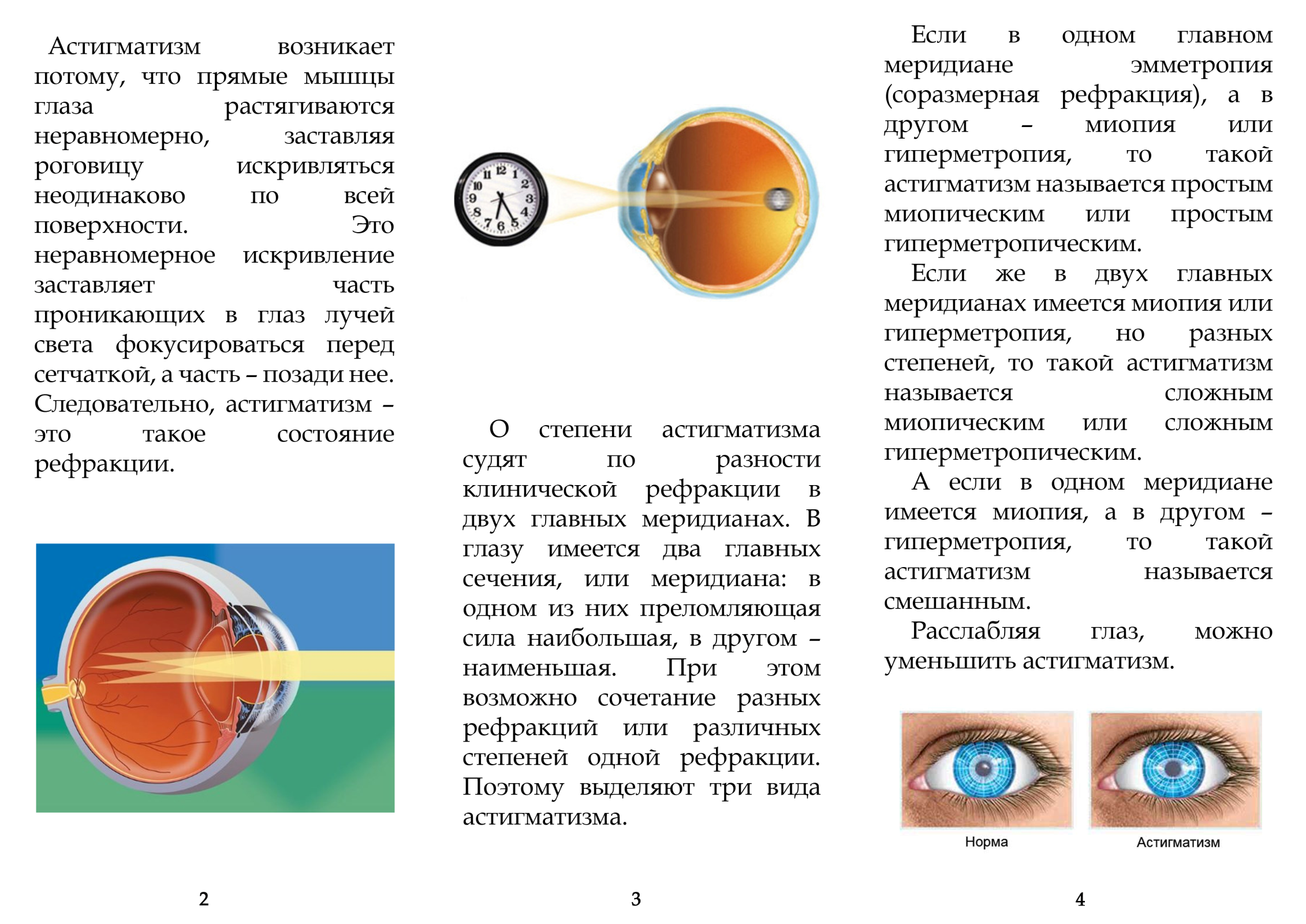 Астигматизм 1 у детей. Миопический астигматизм что это такое простыми словами. Миопия 2 степени сложный миопический астигматизм. Нарушение зрения таблица астигматизм. Искривление роговицы глаза астигматизм.