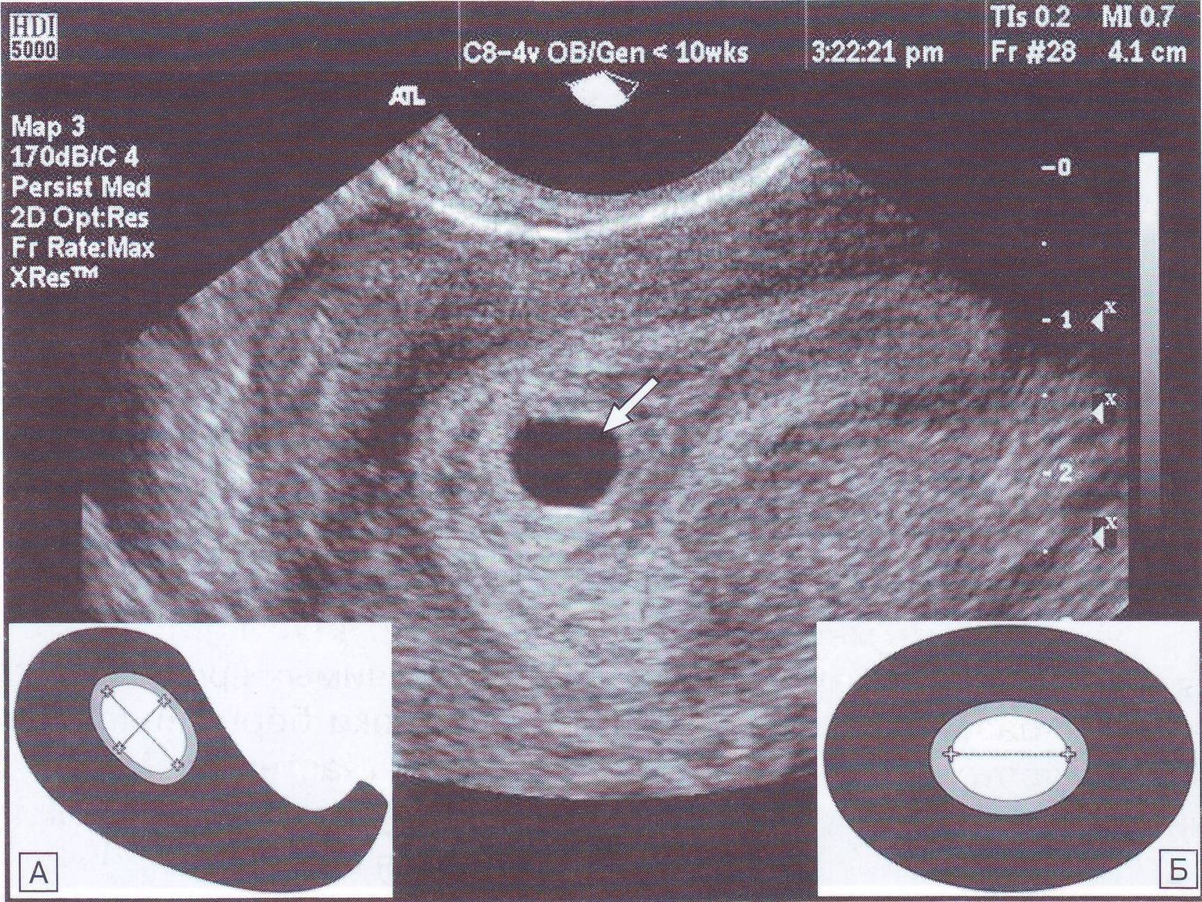 Срок плода 6 недель. Плодное яйцо 4мм эмбрион. УЗИ матки на 5 неделе беременности. Эмбрион на 5 неделе беременности УЗИ. Плодное яйцо по УЗИ 5-6 недель.