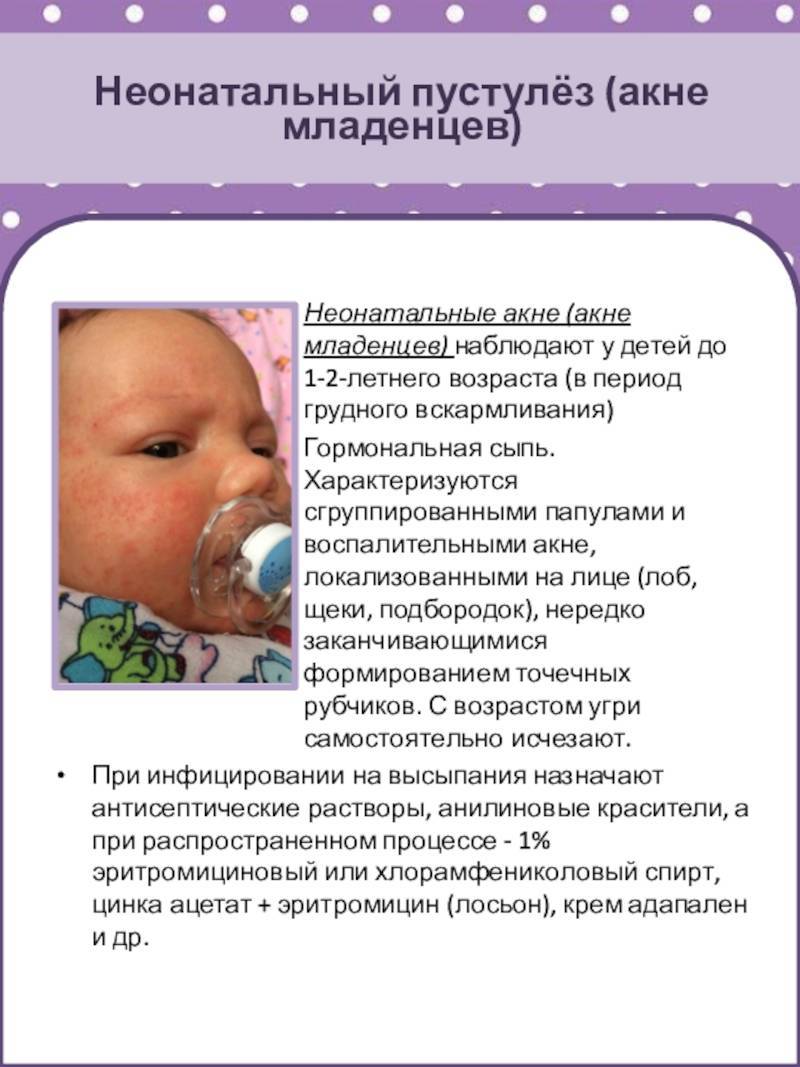 Акне новорожденных: симптомы, лечение и возможные осложнения