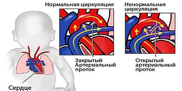 Шумы в сердце у новорожденного ребенка