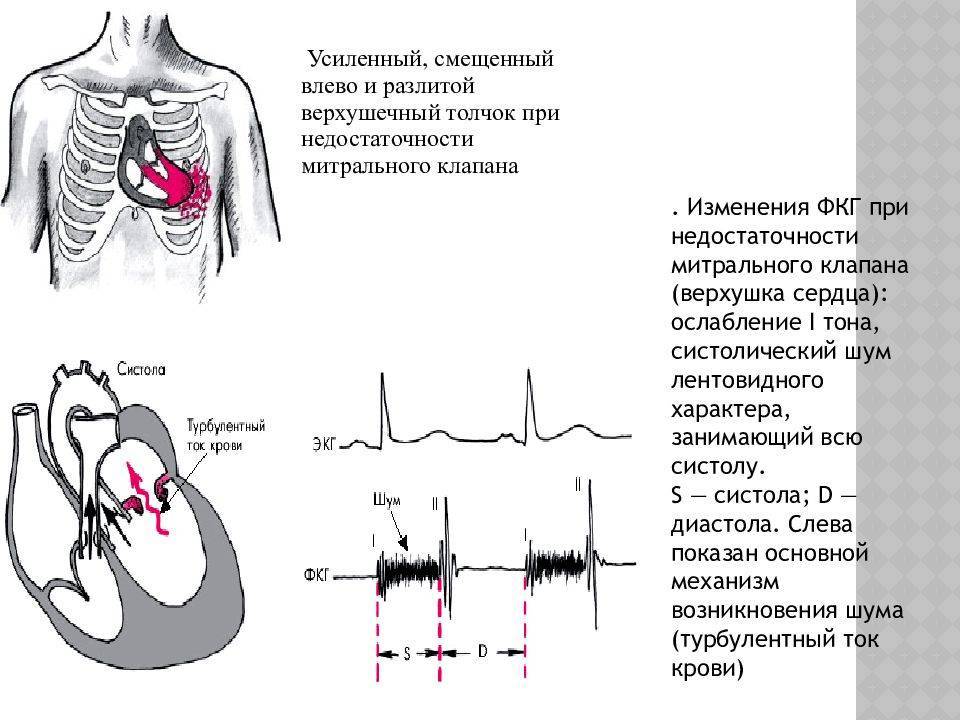 Шумы в сердце у новорожденного, ребенка до года: что это значит, причины возникновения