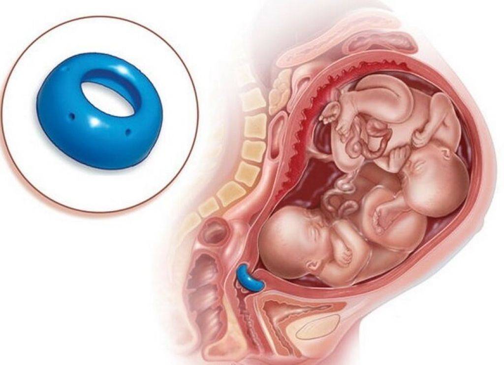 Акушерский пессарий при укорочении шейки матки у беременных