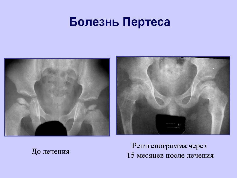 Болезнь пертеса у детей: причины, 7 основных симптомов, 5 стадий, методы лечения