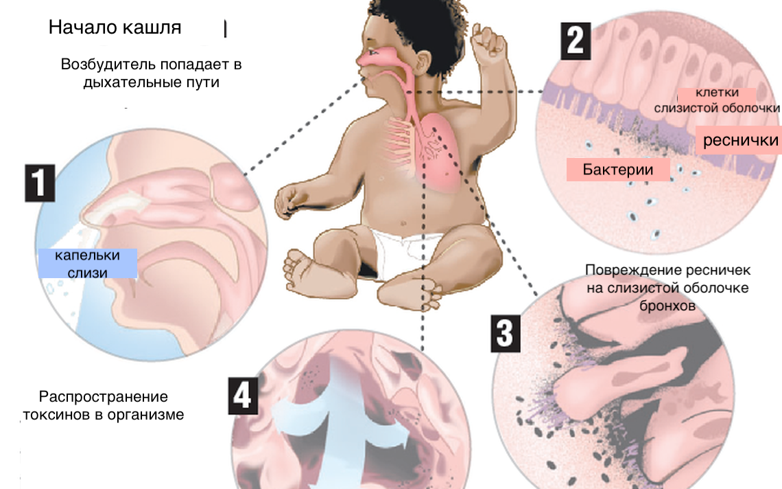 Коклюш механизм передачи. Коклюш паракоклюш патогенез. Bordetella pertussis патогенез. Коклюш у детей клинические проявления.