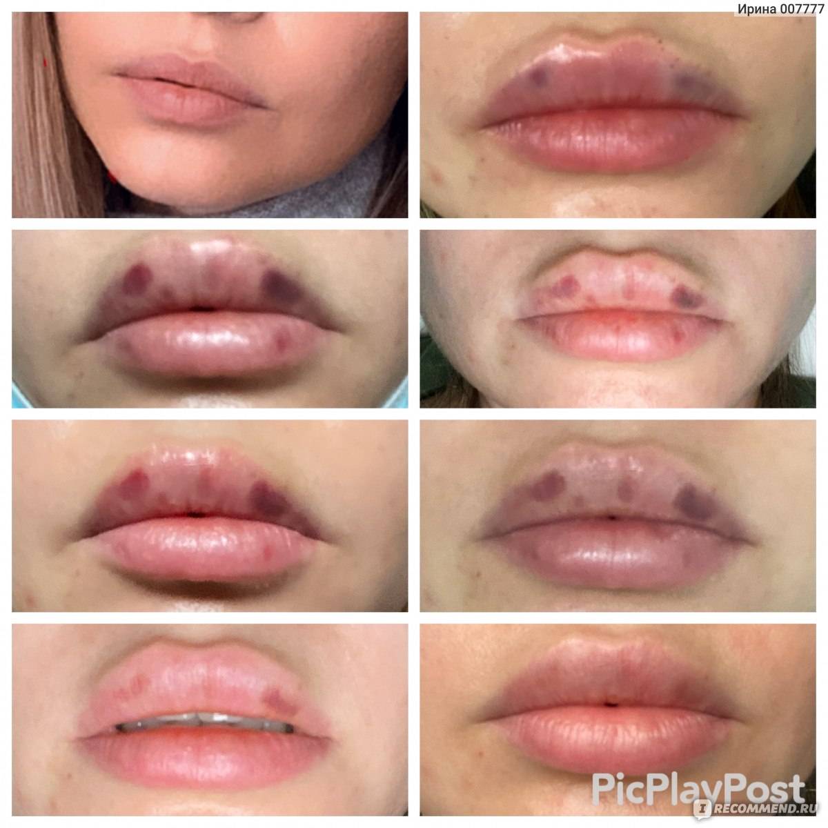 Увеличение губ гиалуроновой кислотой