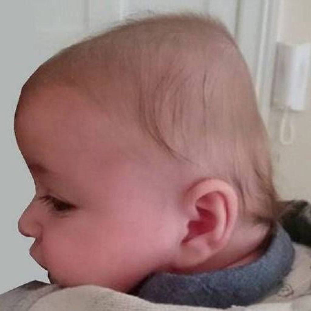 У ребенка выпирает лоб. У ребенка 3 месяца голова наклонена.