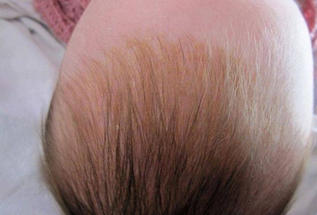 Перхоть у новорожденных (молочные корочки) - клиника «доктор волос»