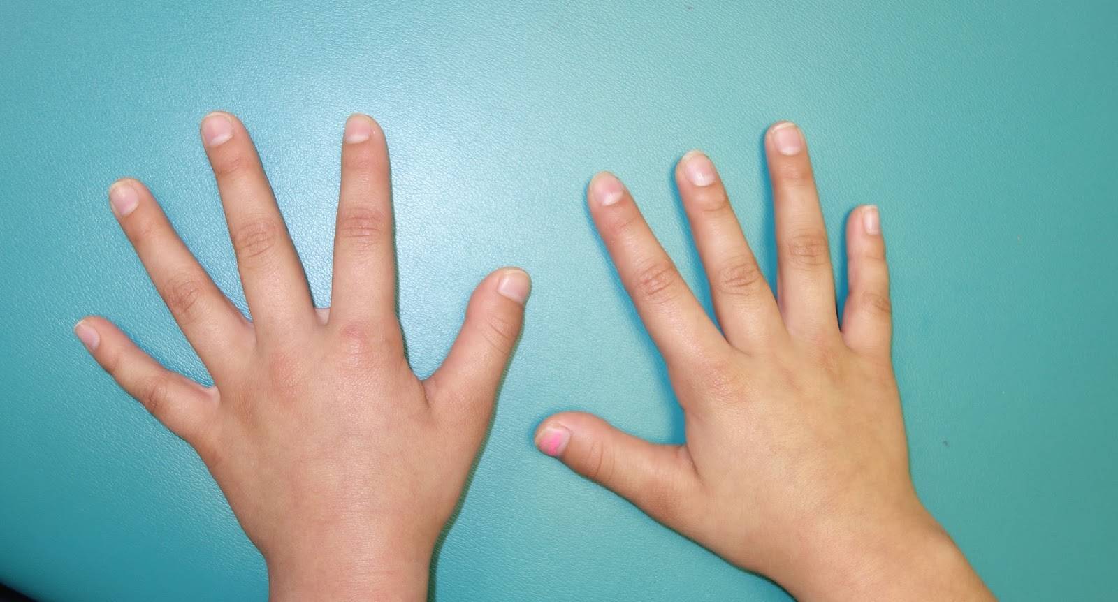 6 пальцев на руках у детей. Синдактилия арахнодактилия. Брахидактилия (короткопалость). Брахидактилия мизинцев. Синдром Дауна брахидактилия.