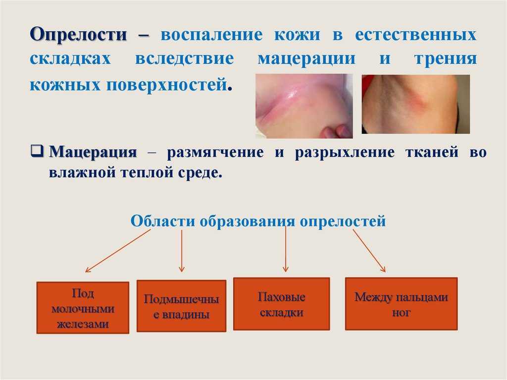 Пеленочный дерматит