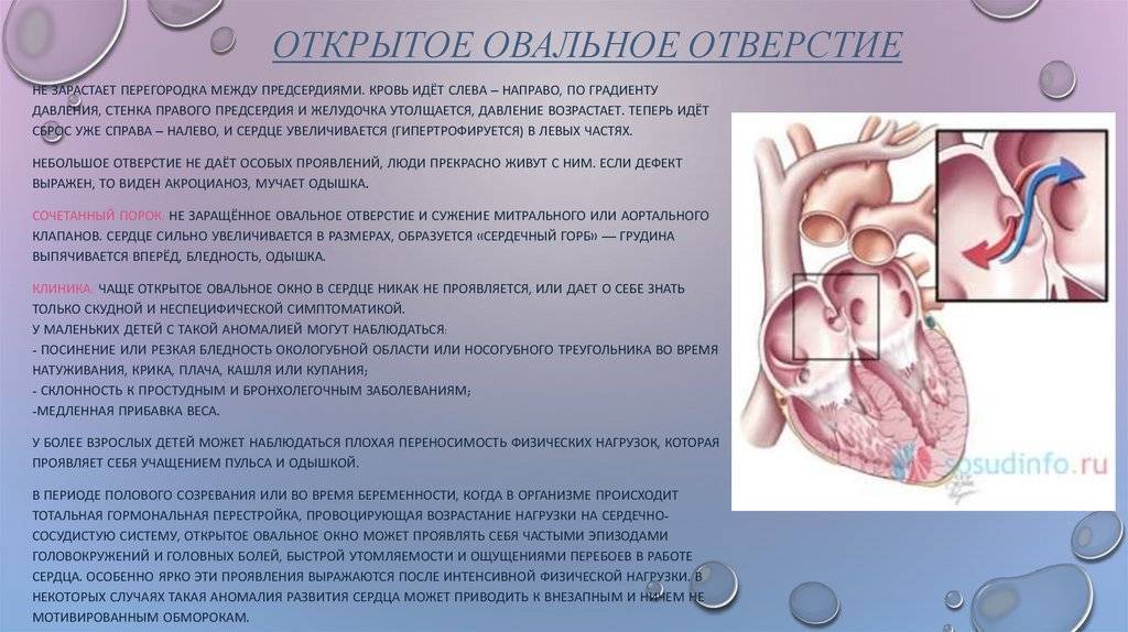Открытое овальное окно в сердце у ребенка: 9 причин, 5 симптомов, чем опасно, лечение, последствия