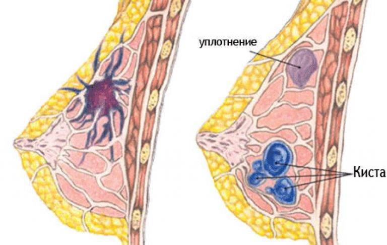 Как лечить болезненное уплотнение в молочной железе при вскармливании?