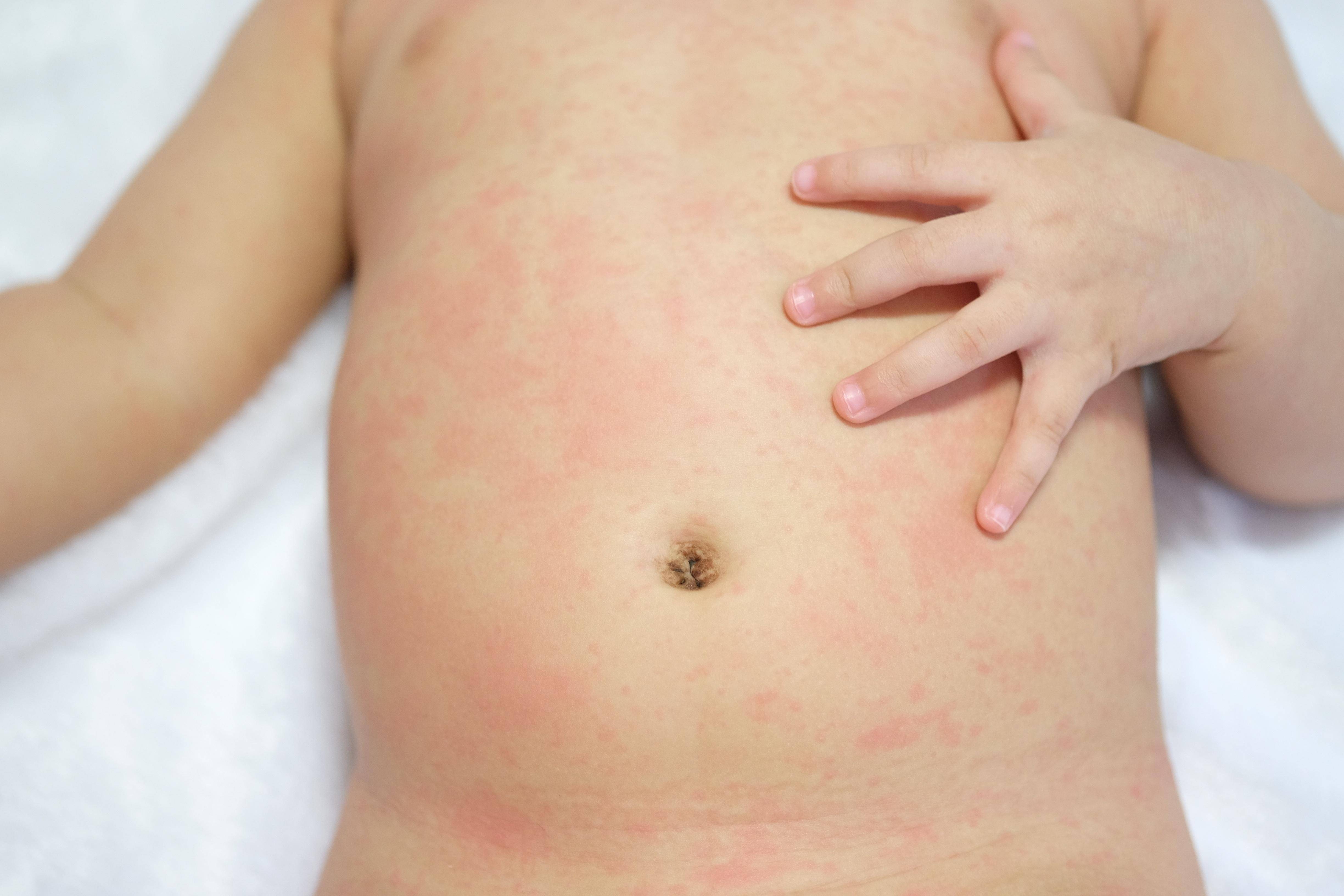 Сыпь у новорожденных аллергия, или неонатальный  пустолез?