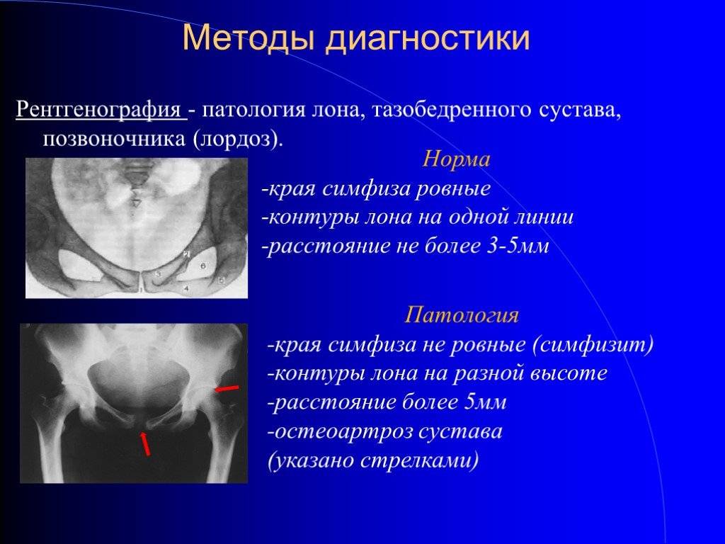 Чем опасен симфизит при беременности. Симфизит. УЗИ лонного сочленения. Ультразвуковое исследование лонного сочленения.