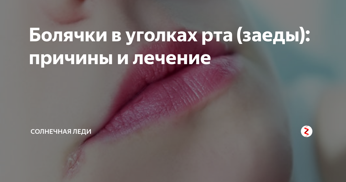 Гель холисал® при заедах в уголках губ (ангулярный хейлит).