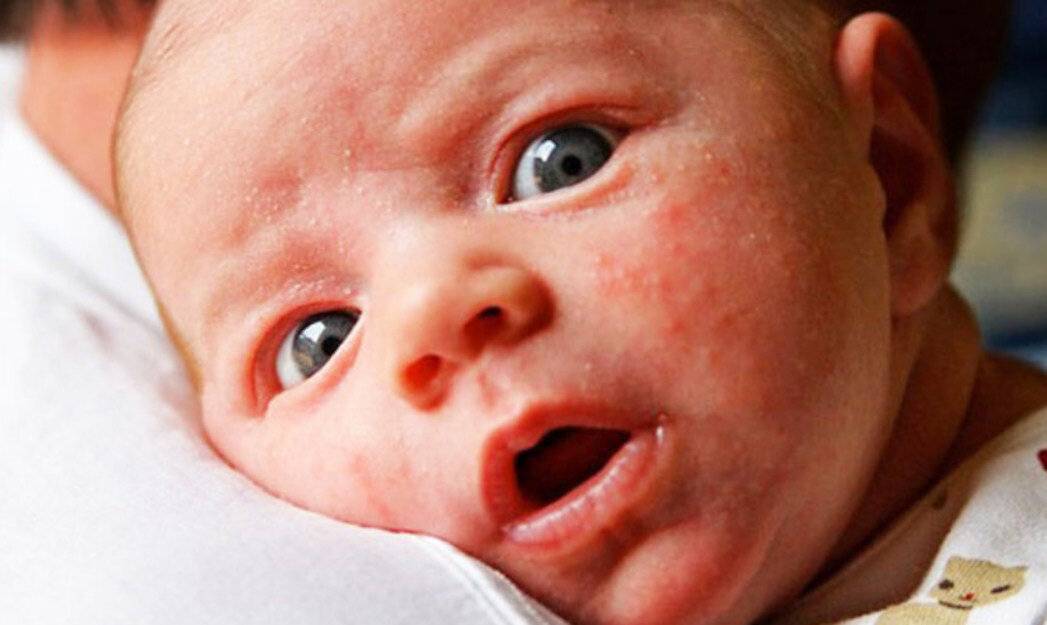 Прыщики на лице у новорожденного: причины, виды высыпаний, лечение и профилактика прыщей