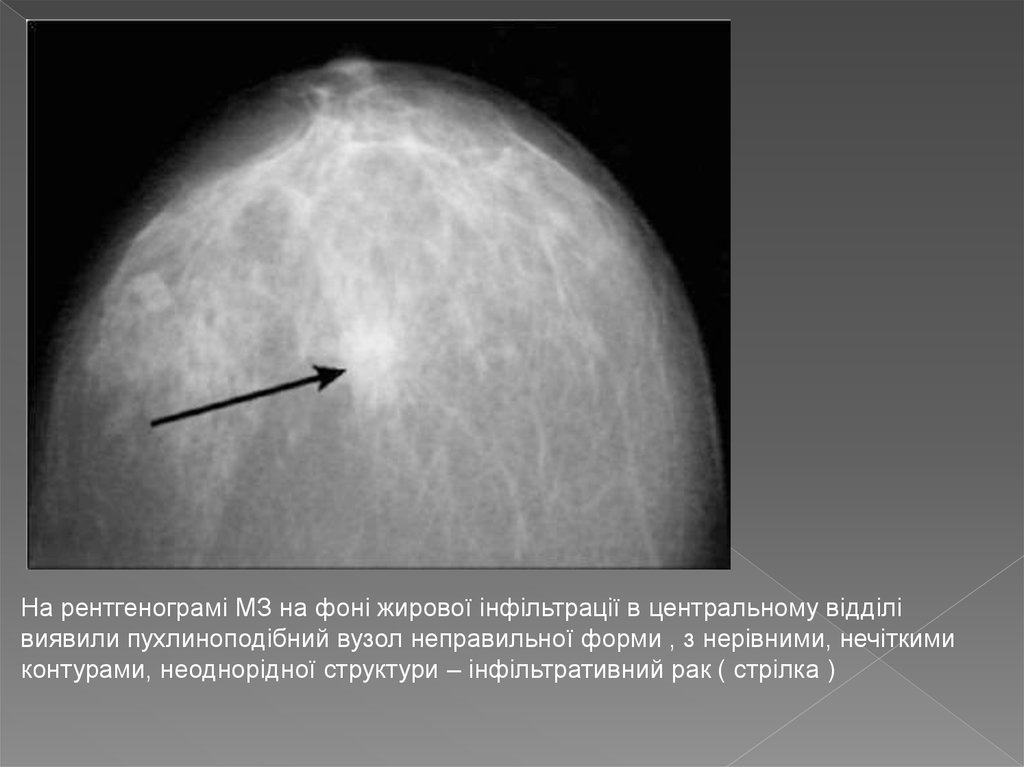 Жировая инволюция молочной железы как лечить