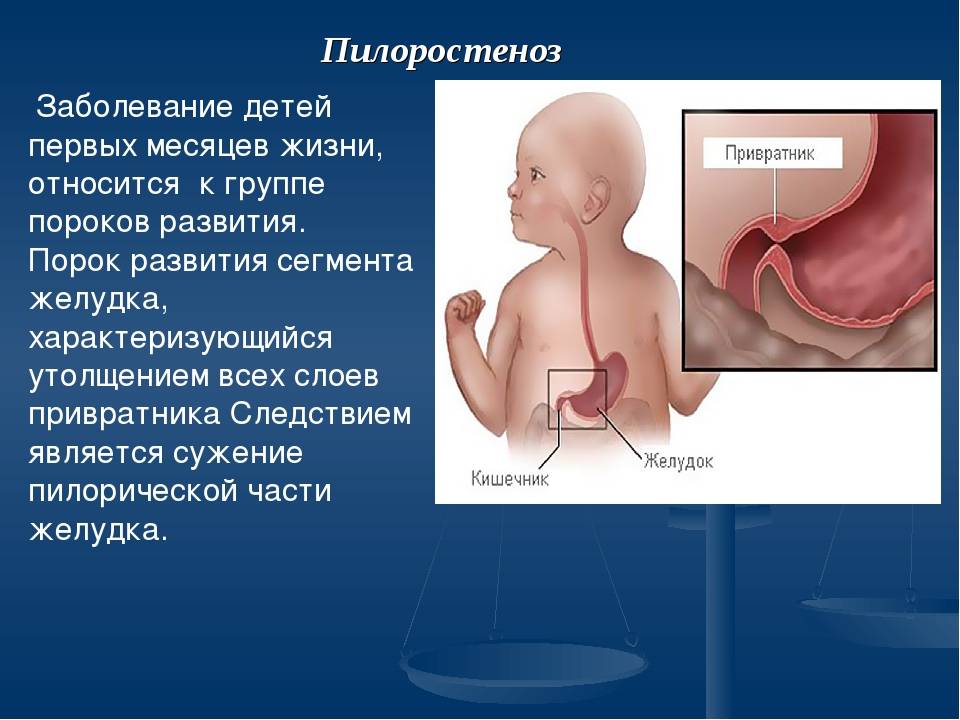Непроходимость желудка у новорожденных - заболевания желудка