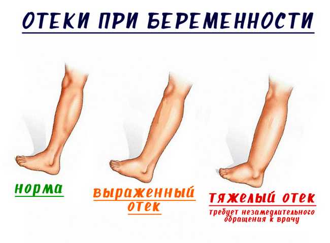 Отеки при беременности