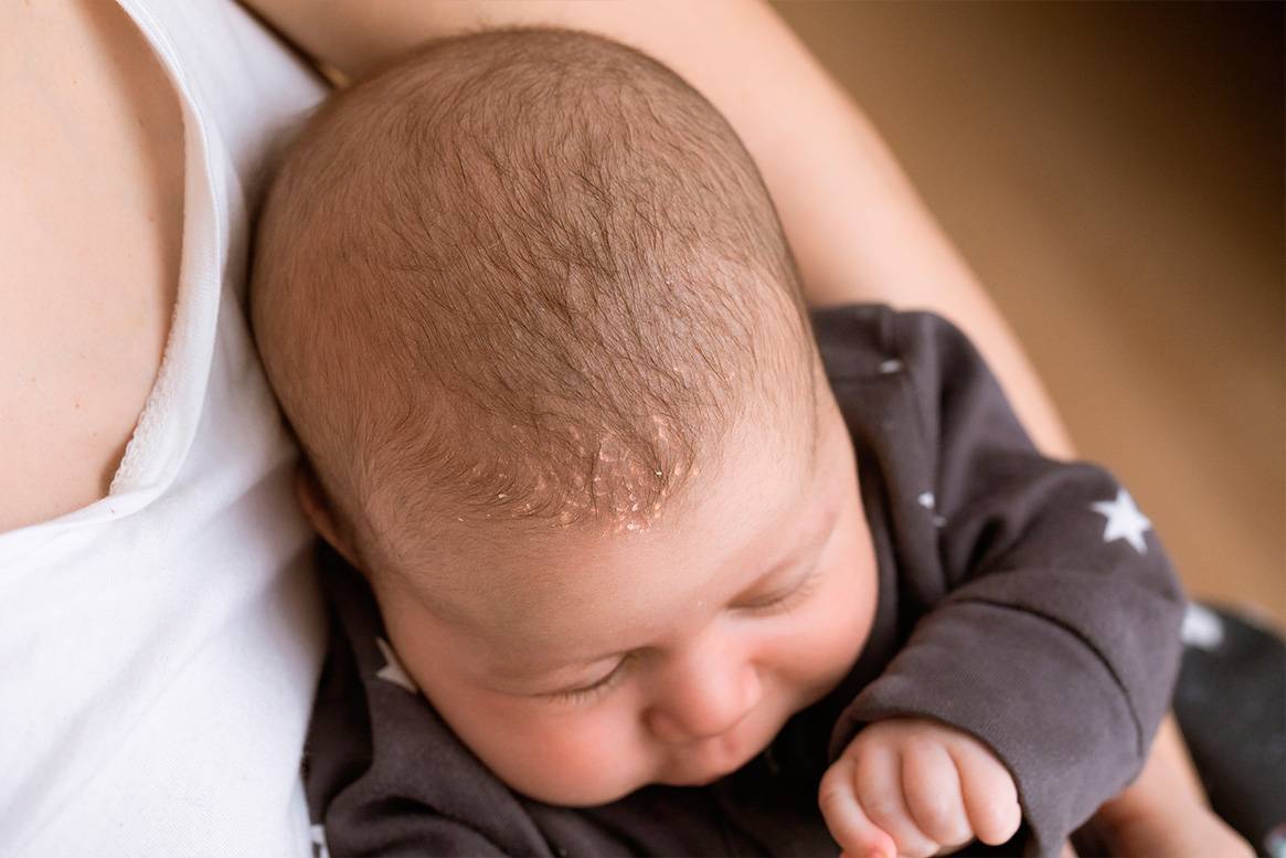 Как убрать корочки с головы младенца: 15 натуральных средств