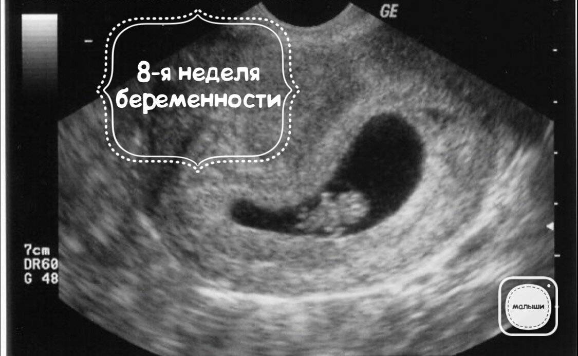 Месячные в 8 недель. Плод на 8 неделе беременности УЗИ. Как выглядит эмбрион в 8 недель на УЗИ. УЗИ на 8 неделе беременности акушерской. Зародыш 8 недель УЗИ.